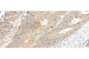 Immunohistochemistry of paraffin-embedded Human colorectal cancer tissue using GPR12 Polyclonal Antibody at dilution of 1:35(x200)