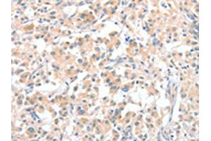 The image on the left is immunohistochemistry of paraffin-embedded Human thyroid cancer tissue using ABIN7128970(CLIP1 Antibody) at dilution 1/30, on the right is treated with fusion protein. (CLIP1 antibody)