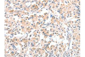 The image on the left is immunohistochemistry of paraffin-embedded Human thyroid cancer tissue using ABIN7128970(CLIP1 Antibody) at dilution 1/30, on the right is treated with fusion protein. (CLIP1 antibody)
