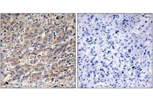 Immunohistochemistry analysis of paraffin-embedded human liver carcinoma tissue, using COX17 Antibody.