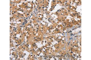 Immunohistochemistry of Human thyroid cancer using BRE Polyclonal Antibody at dilution of 1:40 (BRE antibody)