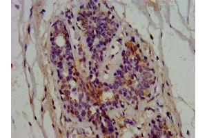 IHC image of ABIN7145566 diluted at 1:600 and staining in paraffin-embedded human breast cancer performed on a Leica BondTM system. (EPRS antibody  (AA 1207-1399))