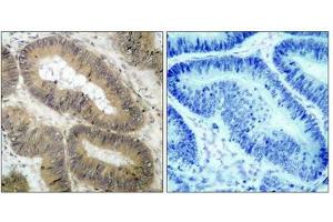 Immunohistochemical analysis of paraffin-embedded human colon carcinoma tissue using IKK a(Phospho-Thr23) Antibody(left) or the same antibody preincubated with blocking peptide(right). (IKK alpha antibody  (pThr23))