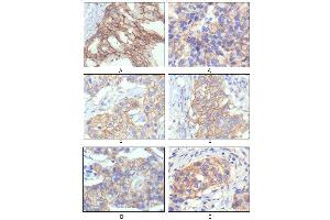 Immunohistochemical analysis of paraffin-embedded human breast intraductal carcinama tissue(A) and breast infiltrating ductal carcinama tissue(B) showing membrane localization using HER-2 mouse mAb with DAB staining. (ErbB2/Her2 antibody)