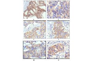 Immunohistochemical analysis of paraffin-embedded human breast intraductal carcinama tissue(A) and breast infiltrating ductal carcinama tissue(B) showing membrane localization using HER-2 mouse mAb with DAB staining. (ErbB2/Her2 antibody)