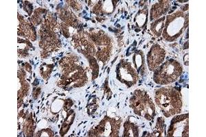 Immunohistochemical staining of paraffin-embedded Adenocarcinoma of ovary tissue using anti-AKR1A1 mouse monoclonal antibody. (AKR1A1 antibody)