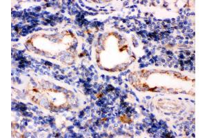 TPP1 was detected in paraffin-embedded sections of human lung cancer tissues using rabbit anti- TPP1 Antigen Affinity purified polyclonal antibody at 1 μg/mL. (TPP1 antibody  (Middle Region))