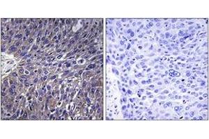 Immunohistochemistry analysis of paraffin-embedded human lung carcinoma tissue, using USP50 Antibody.