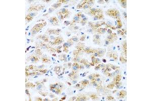 Immunohistochemistry of paraffin-embedded human liver cancer using KIAA1456 antibody at dilution of 1:200 (40x lens). (KIAA1456 antibody)
