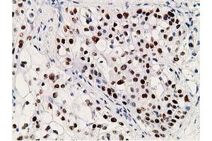 Immunohistochemical staining of paraffin-embedded Carcinoma of Human pancreas tissue using anti-TP53 mouse monoclonal antibody. (p53 antibody)