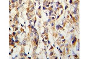 IHC analysis of FFPE human breast carcinoma with Keratin-14 antibody (KRT14 antibody  (AA 276-303))