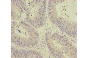 Immunohistochemistry of paraffin-embedded human colon cancer using ABIN7159631 at dilution of 1:100 (MCCC1 antibody  (AA 526-725))