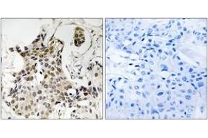 Immunohistochemistry analysis of paraffin-embedded human breast carcinoma tissue, using HP1 gamma (Ab-93) Antibody.