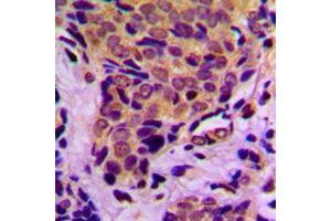 Immunohistochemical analysis of 4EBP1 (pT37) staining in human breast cancer formalin fixed paraffin embedded tissue section. (eIF4EBP1 antibody  (N-Term, pSer37))