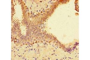 Immunohistochemistry of paraffin-embedded human prostate cancer using ABIN7172704 at dilution of 1:100 (SUPT3H/SPT3 antibody  (AA 1-328))