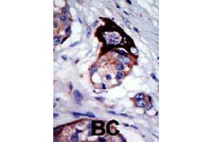 Formalin-fixed and paraffin-embedded human cancer tissue reacted with MARK3 polyclonal antibody  , which was peroxidase-conjugated to the secondary antibody, followed by AEC staining. (MARK3 antibody  (C-Term))