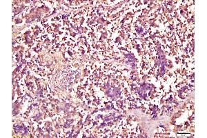 Formalin-fixed and paraffin embedded human lung carcinoma labeled with Anti-Smad1 Polyclonal Antibody, Unconjugated (ABIN732158) at 1:200 followed by conjugation to the secondary antibody and DAB staining (Smad1/5 antibody  (AA 361-465))
