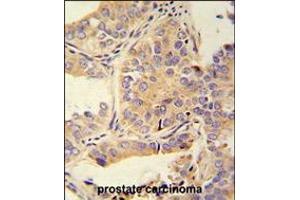 UBA52 antibody immunohistochemistry analysis in formalin fixed and paraffin embedded human prostate carcinoma followed by peroxidase conjugation of the secondary antibody and DAB staining.