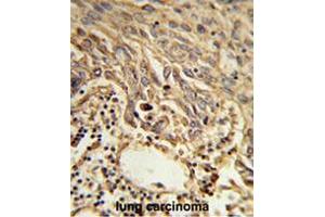 Formalin-fixed and paraffin-embedded human lung carcinoma reacted with EIF4A2 Antibody (C-term), which was peroxidase-conjugated to the secondary antibody, followed by DAB staining. (EIF4A2 antibody  (C-Term))