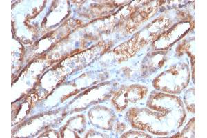 Formalin-fixed, paraffin-embedded human Renal Cell Carcinoma stained with Mitochondria Monoclonal Antibody (MTC719) (Mitochondrial Marker antibody)
