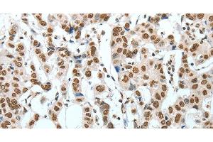 Immunohistochemistry of paraffin-embedded Human breast cancer using BNIP1 Polyclonal Antibody at dilution of 1:60 (BNIP1 antibody)