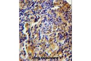 CK073 Antibody (N-term) immunohistochemistry analysis in formalin fixed and paraffin embedded human lung carcinoma followed by peroxidase conjugation of the secondary antibody and DAB staining. (C11orf73 antibody  (N-Term))