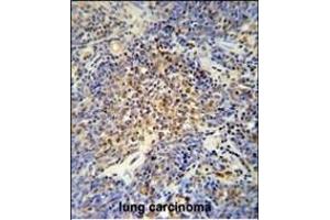 OTUD4 antibody (N-term) (ABIN652177 and ABIN2840579) immunohistochemistry analysis in formalin fixed and paraffin embedded human lung carcinoma followed by peroxidase conjugation of the secondary antibody and DAB staining.
