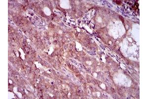 Immunohistochemical analysis of paraffin-embedded cervical cancer tissues using EGFR mutant mouse mAb with DAB staining. (EGFR Mutant (AA 693-893) antibody)