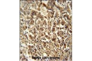 DIS3 antibody (Center) (ABIN654155 and ABIN2844022) immunohistochemistry analysis in formalin fixed and paraffin embedded human testis carcinoma followed by peroxidase conjugation of the secondary antibody and DAB staining. (DIS3 antibody  (AA 295-323))