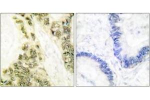 Immunohistochemistry analysis of paraffin-embedded human colon carcinoma tissue, using Thyroid Hormone Receptor alpha Antibody. (THRA antibody  (AA 10-59))
