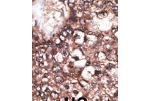 Formalin-fixed and paraffin-embedded human cancer tissue reacted with the primary antibody, which was peroxidase-conjugated to the secondary antibody, followed by DAB staining. (LRP8 antibody  (C-Term))