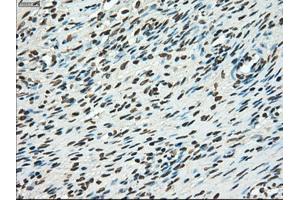 Immunohistochemical staining of paraffin-embedded Adenocarcinoma of breast tissue using anti-TYRO3 mouse monoclonal antibody. (TYRO3 antibody)