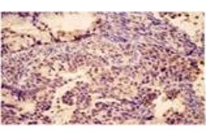 Immunohistochemistry analysis of human cervical cancer tissue with Bak pAb. (BAK1 antibody)