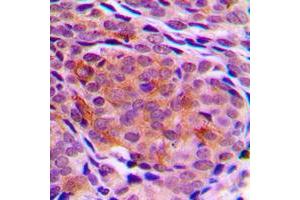 Immunohistochemical analysis of TCTP staining in human breast cancer formalin fixed paraffin embedded tissue section. (TPT1 antibody  (Center))