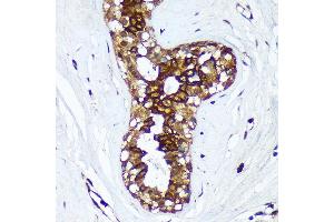 Immunohistochemistry of paraffin-embedded Human breast cancer using HSD17B7 Rabbit pAb (ABIN7267812) at dilution of 1:100 (40x lens). (HSD17B7 antibody  (AA 110-200))