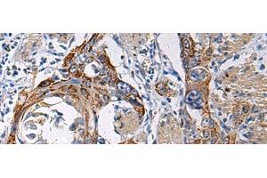 Immunohistochemistry of paraffin-embedded Human esophagus cancer tissue using RITA1 Polyclonal Antibody at dilution of 1:60(x200)