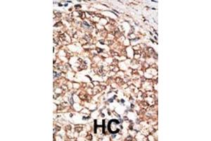 Formalin-fixed and paraffin-embedded human cancer tissue reacted with the primary antibody, which was peroxidase-conjugated to the secondary antibody, followed by DAB staining. (BMPR1B antibody  (C-Term))