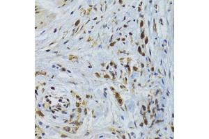 Immunohistochemistry of paraffin-embedded human gastric cancer using GABPB1 Antibody (ABIN2562720) at dilution of 1:100 (40x lens). (GABPB1 antibody)