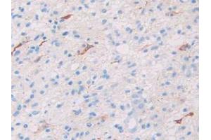 IHC-P analysis of Human Glioma Tissue, with DAB staining. (SLIT1 antibody  (AA 647-835))