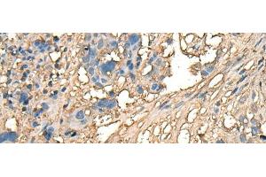 Immunohistochemistry of paraffin-embedded Human lung cancer tissue using CELA1 Polyclonal Antibody at dilution of 1:70(x200) (CELA1 antibody)