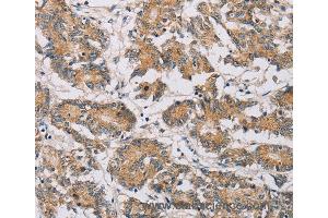 Immunohistochemistry of Human colon cancer using MTFR1 Polyclonal Antibody at dilution of 1:30 (MTFR1 antibody)