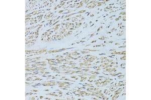 Immunohistochemistry of paraffin-embedded human uterine cancer using SLC40A1 antibody (ABIN6292414) at dilution of 1:100 (40x lens).