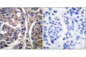 Immunohistochemistry analysis of paraffin-embedded human breast carcinoma tissue, using Keratin 20 Antibody.