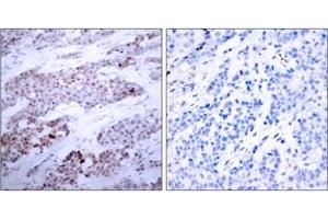 Immunohistochemistry analysis of paraffin-embedded human breast carcinoma, using ATF4 (Phospho-Ser245) Antibody. (ATF4 antibody  (pSer245))