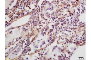 Formalin-fixed and paraffin embedded human colon carcinoma labeled with Rabbit Anti-CLEC5A/MDL1 Polyclonal Antibody (ABIN748763) at 1:200 followed by conjugation to the secondary antibody and DAB staining.