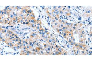 Immunohistochemistry of paraffin-embedded Human lung cancer using IMMT Polyclonal Antibody at dilution of 1:70