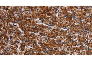 Immunohistochemistry of paraffin-embedded Human prostate cancer tissue using LRRC15 Polyclonal Antibody at dilution 1:60 (LRRC15 antibody)
