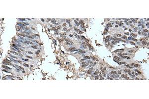 Immunohistochemistry of paraffin-embedded Human colorectal cancer tissue using HELLS Polyclonal Antibody at dilution of 1:30(x200)