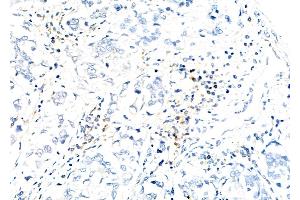 ABIN6260295 and ABIN6279783 at 1/100 staining Human liver cancer by IHC-P.