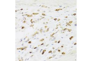 Immunohistochemistry of paraffin-embedded human gastric cancer using LSP1 Antibody (ABIN5973271) at dilution of 1/100 (40x lens). (LSP1 antibody)